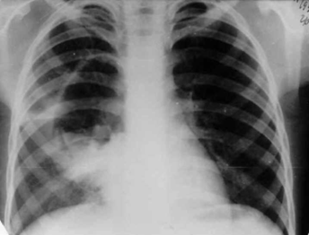 При такой рентгенологической картине необходимо проводить дифференциальную диагностику