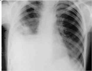 При такой рентгенологической картине необходимо проводить дифференциальную диагностику